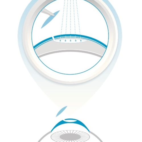 Relex Smile Dr. Kocmut Augenlaser Zeiss