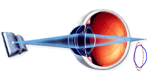 presbyopia2_augenarzt DDr. Kocmut